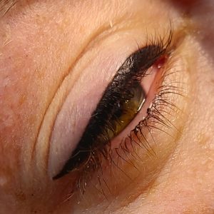 PMU ogen | Skinnovations